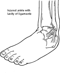 Preventing Recurrent Ankle Sprains - The Physio Company